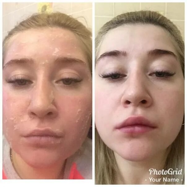 Как должно выглядеть лицо после пилинга Does Tca Peels Remove Wrinkles Top Sellers --p1ai