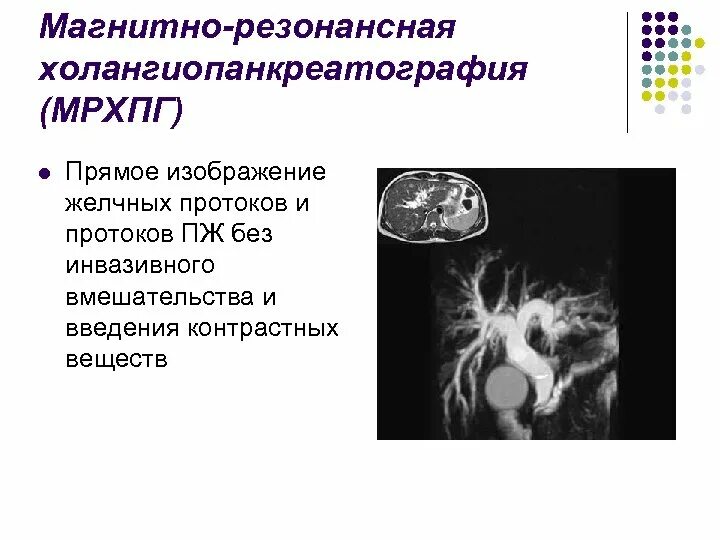 Магнитно-резонансная холангиопанкреатография при ЖКБ. Холангиография жёлчных протоков. МРХПГ поджелудочной железы. Магнитно резонансная холангиопанкреатография МРХПГ.