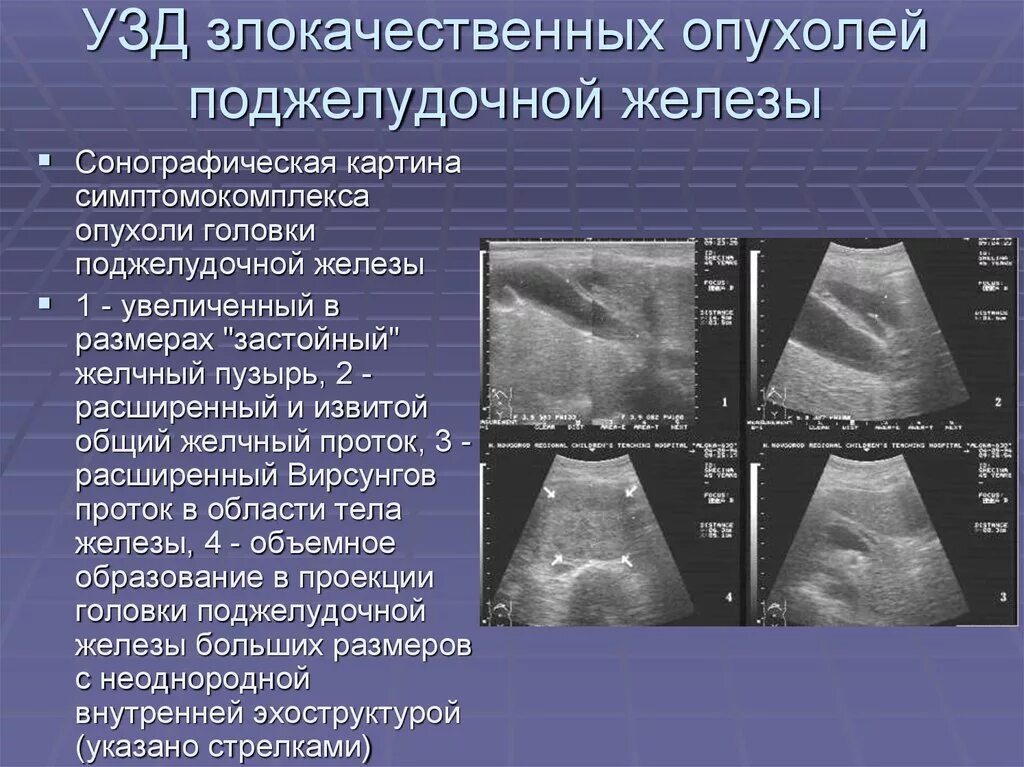 Доброкачественное образование печени. Доброкачественные опухоли поджелудочной железы на УЗИ. Опухоль хвоста поджелудочной железы на УЗИ. УЗИ поджелудочной железы протокол. Образование головки поджелудочной железы на УЗИ.