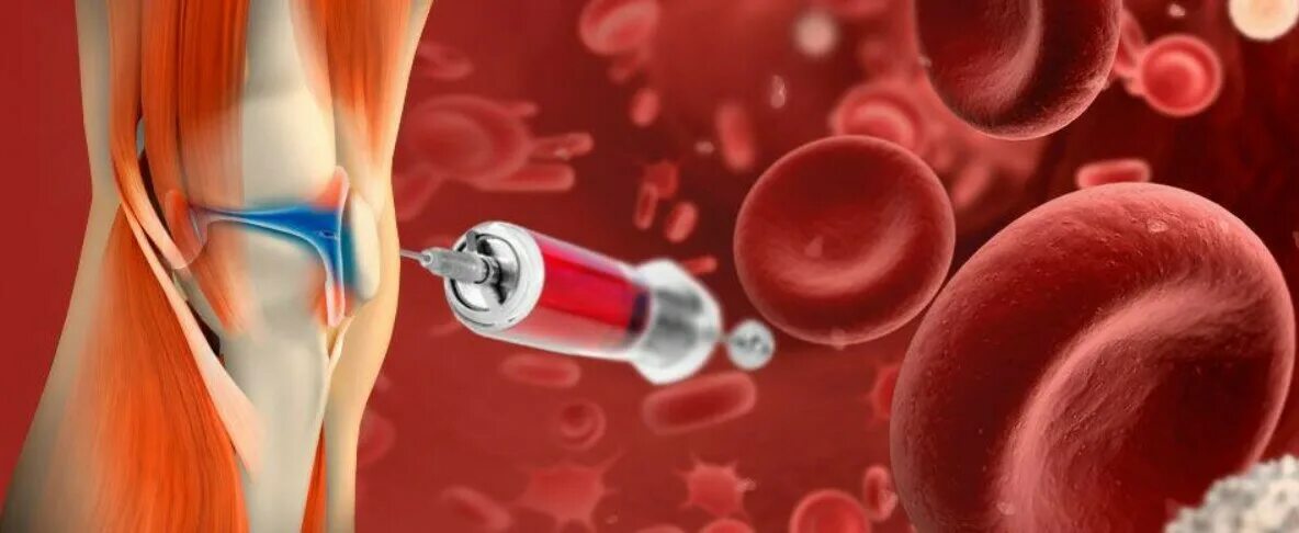 Плазмотерапия PRP. Плазмолифтинг PRP терапия коленного сустава. PRP терапия Platelet Rich Plasma. Плазмотерапия в травматологии и ортопедии. Плазмолифтинг суставов что это