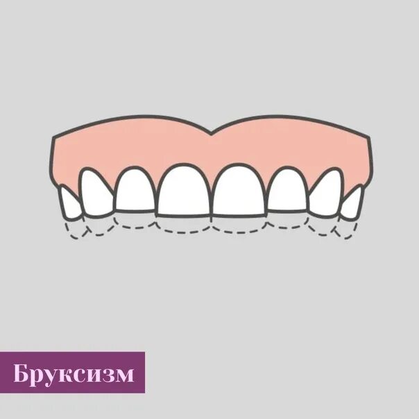 Бруксизм это что такое у взрослых. Бруксизм это что такое у взрослых