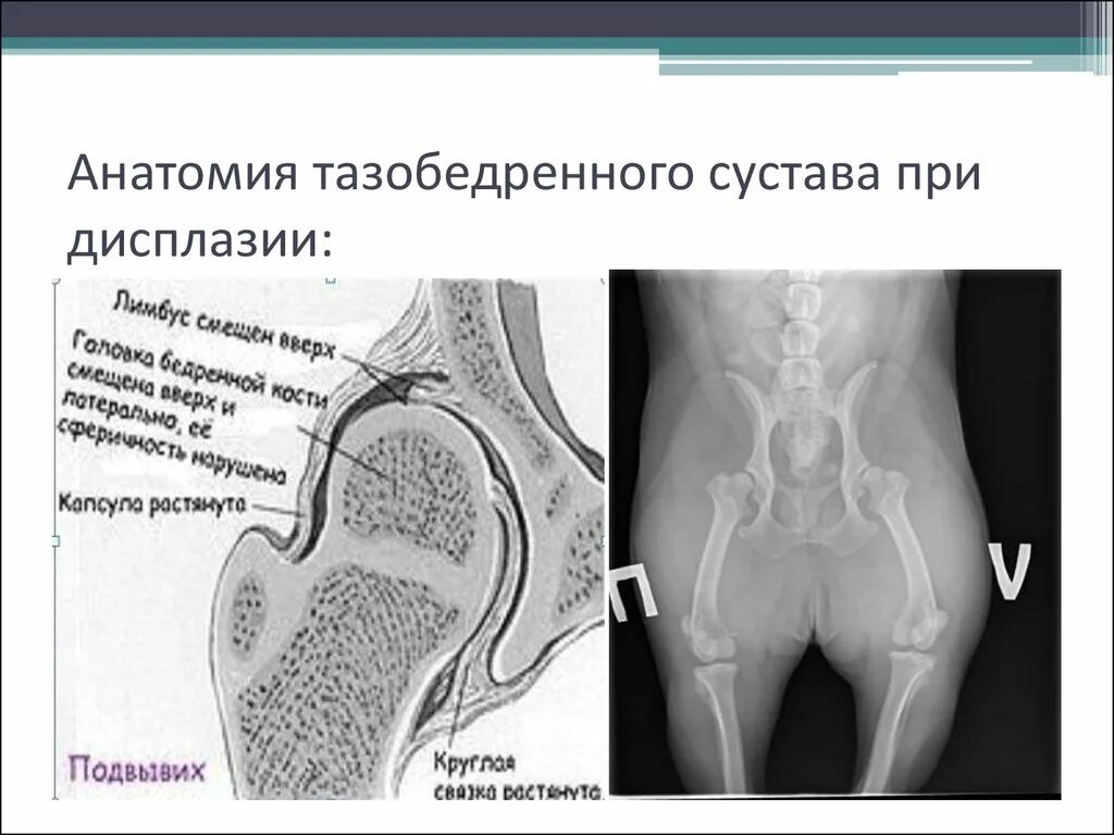 Лимбус тазобедренного сустава это. Снимки дисплазия тазобедренного сустава. лимбус анатомия тазобедренного. дисплазия суставов колена. дисплазия тазобедренных суставов.
