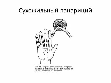 Вскрыть палец