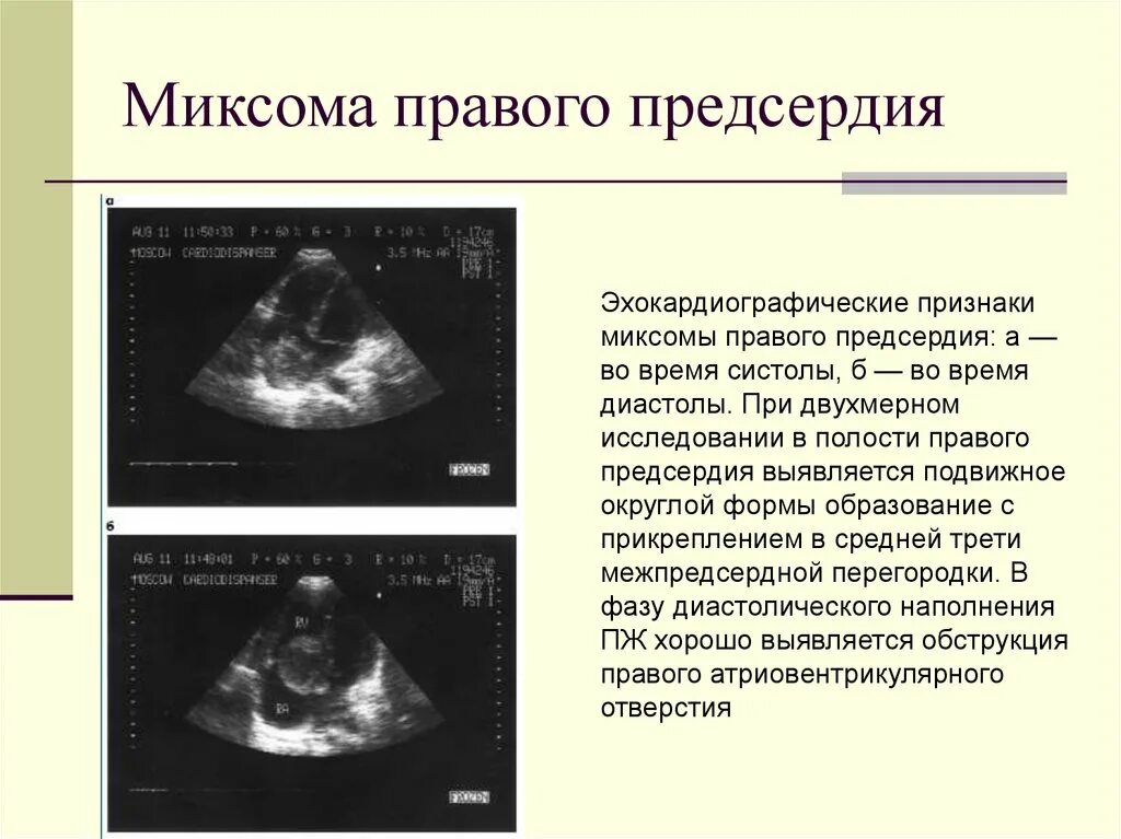 Образование левого предсердия. Миксома правого желудочка. Миксома митрального клапана. Миксома предсердия левого предсердия на Эхо. Доброкачественная опухоль сердца миксома.