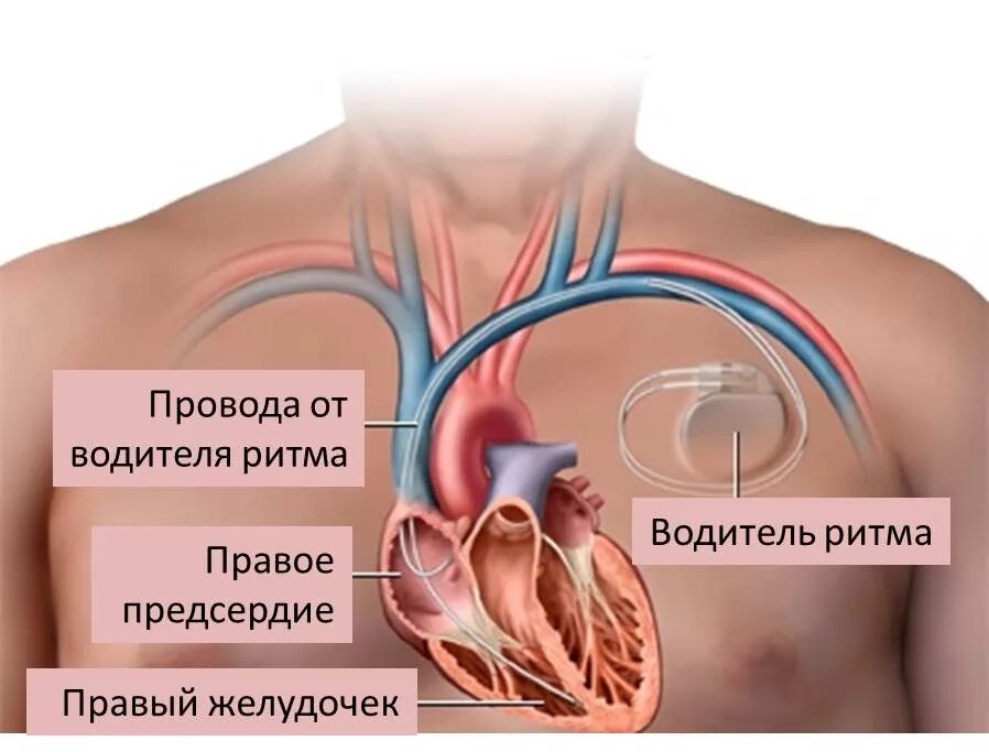 Водители ритма сердца. Искусственный водитель ритма. Двухкамерный кардиостимулятор. Искусственный водитель ритма сердца.