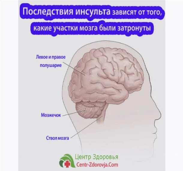 Какая сторона инсульта опаснее правая или левая