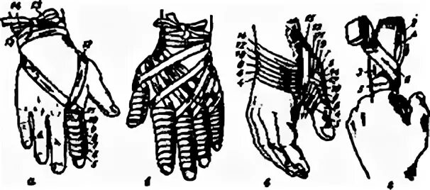 Техника наложения повязки на кисть