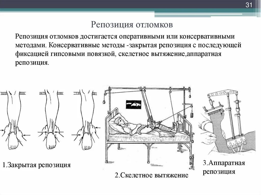 Репозиция отломков при переломе. Закрытая ручная одномоментная репозиция. способы репозиции отломков. способы репозиции костных отломков. аппаратная репозиция переломов.