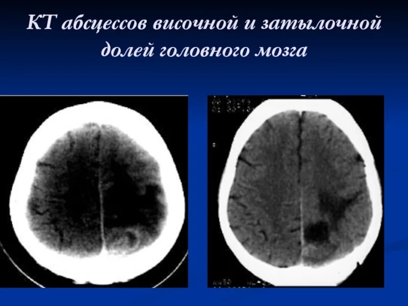 Абсцесс мозга. Абсцесс головного мозга патанатомия. Риногенный абсцесс головного мозга. Абсцесс затылочной доли головного мозга кт. Кт абсцесса височной доли.