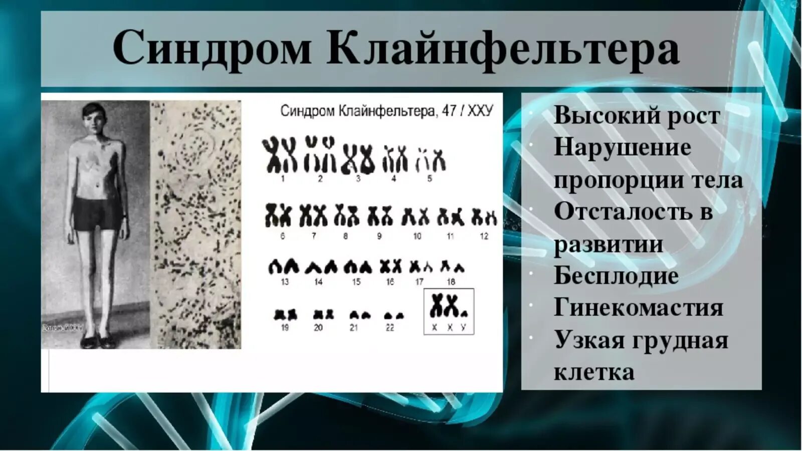 Синдром Клайнфельтера 47 xxy. Синдром Клайнфельтера кариотип. Синдром Клайнфельтера (у мужчин 47 хромосом -ХХУ). Хромосомная формула Клайнфельтера.