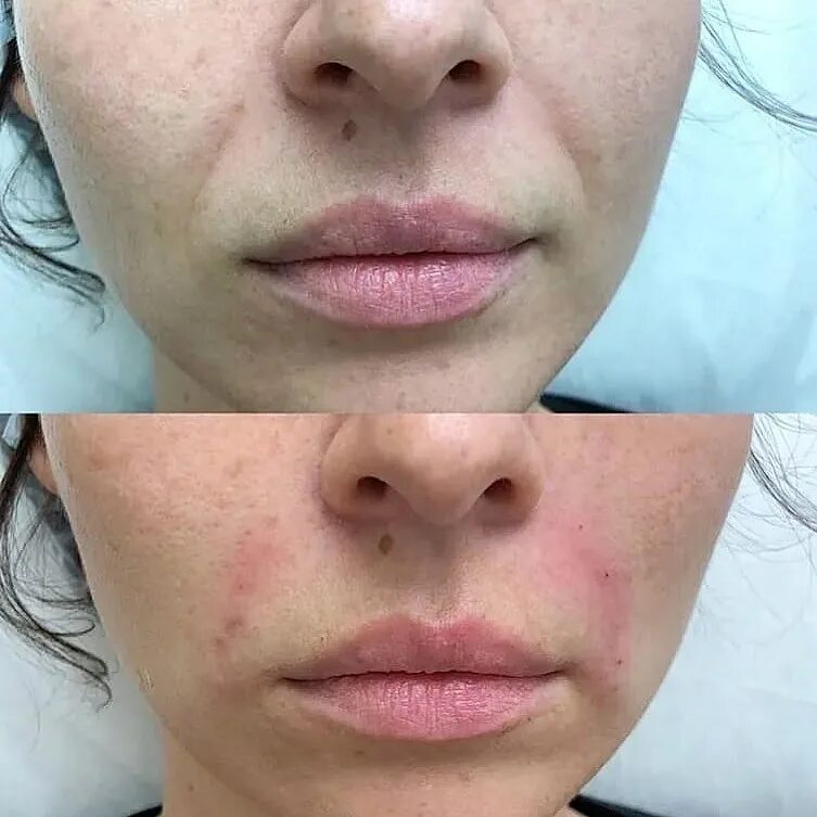 Носогубка заполнение филлерами до и после. Контурная пластика носогубных складок. Филеры в носогубные складки. Филлеры в носогубные складки. Носогубки гиалуроновой кислотой.