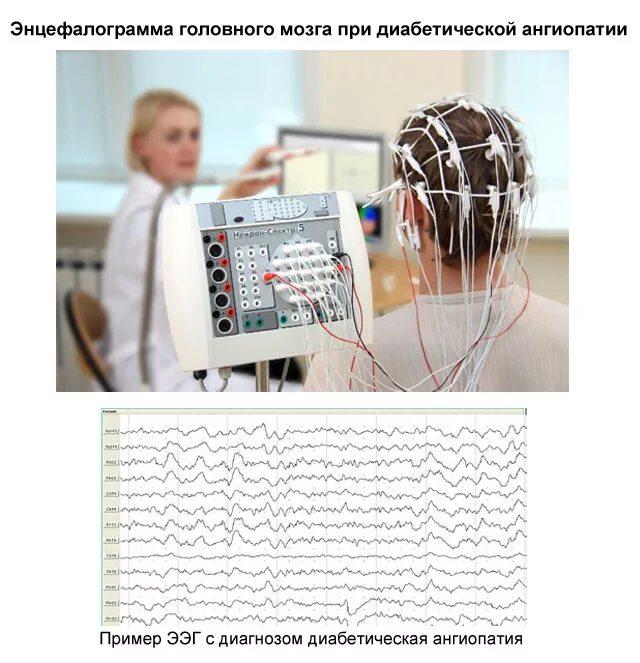 Ээг мозга цена. Электроэнцефалография головного мозга. Электроэнцефалография в поликлинике. УЗИ ЭЭГ. Электроцифограмма головного мозга.