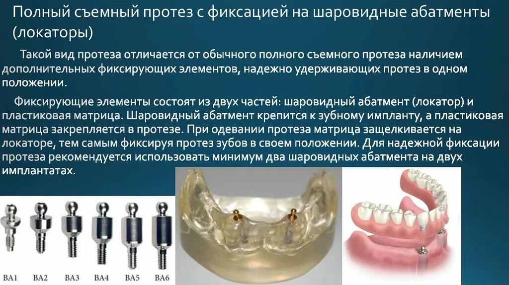 Съемные конструкции зубных протезов. Съемный протез на имплантах. Балочная фиксация съемных протезов. Съемные ортопедические конструкции.