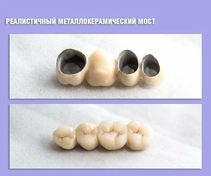 Поставить мост из металлокерамики. Металлокерамическая коронка а1 120. фрезерованная металлокерамическая коронка. металлокерамический мост. металлокерамическая коронка мост.