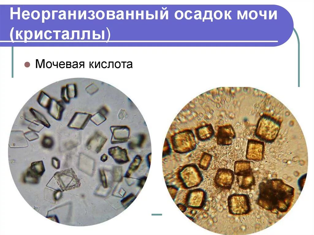 Кристаллы мочевой кислоты микроскопия. Соли в кислой моче микроскопия. Соли мочевой кислоты в моче микроскопия. Микроскопия неорганизованного осадка мочи.