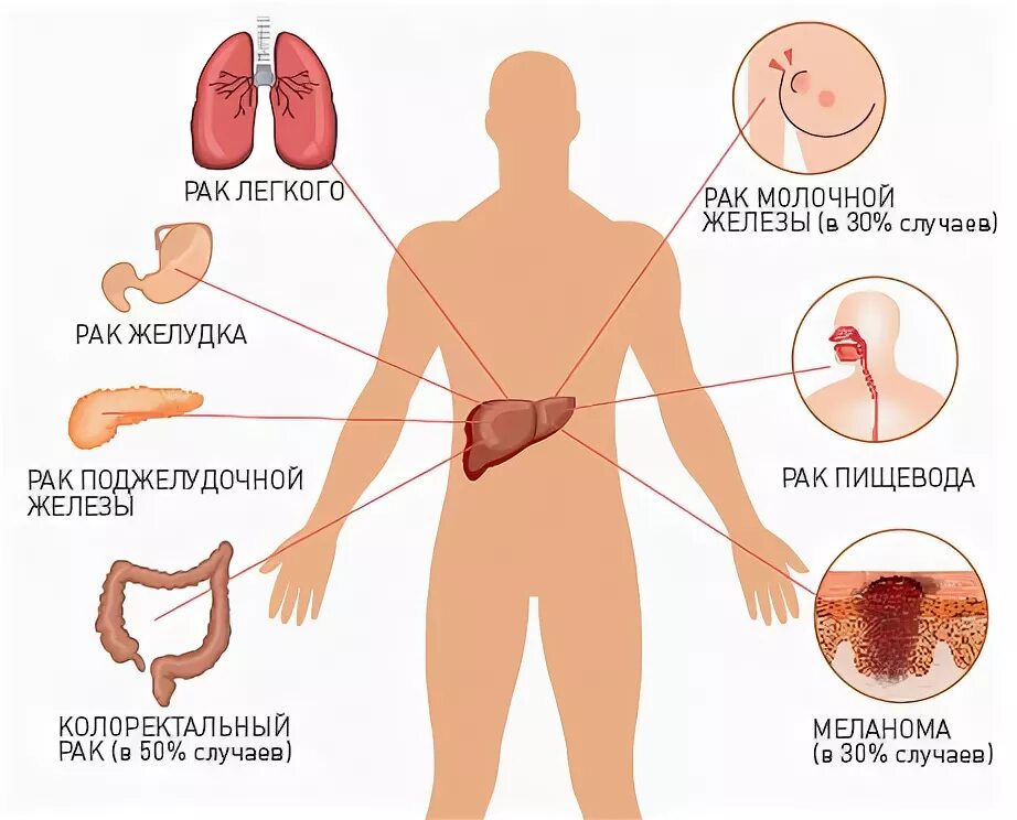 Печень и молочные железы. Метастатическое поражение печени. Печень и желудок онкология.