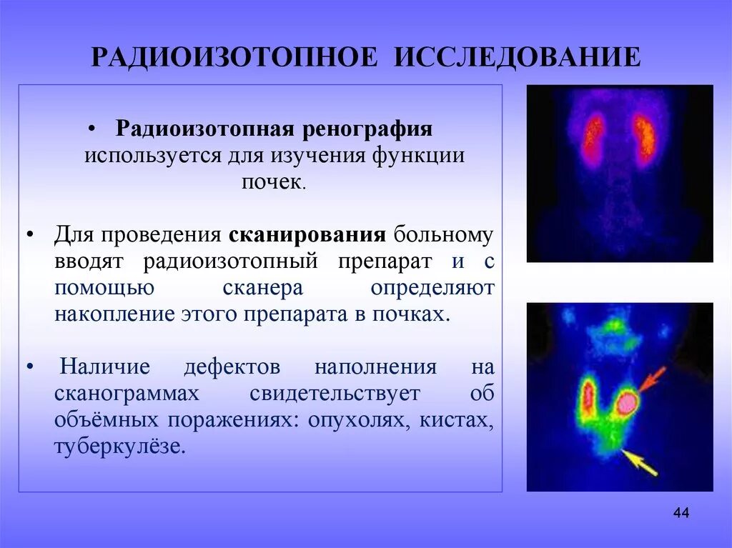 Радиоизотопный метод исследования почек. Методика проведения радиоизотопного исследования почек. Радиоизотопное исследование (сцинтиграфия почек. Радиоизотопное исследование почек позволяет оценить.