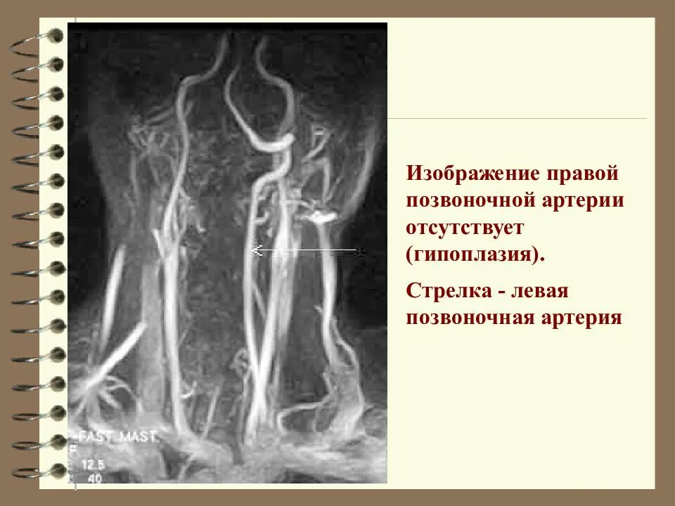 Интракраниальные сегменты позвоночных артерий. Гипоплазия v4 сегмента правой позвоночной артерии. Позвоночная артерия анатомия схема. Правая па артерия. Гипоплазия v4 сегмента левой позвоночной артерии.