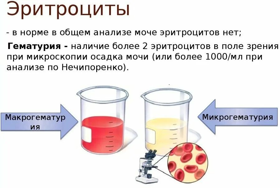 Моча кровь что пить. Микрогематурия норма эритроцитов в моче. Причины наличия эритроцитов в моче. Кетоциты в моче у женщин. Обнаружение крови в моче это.