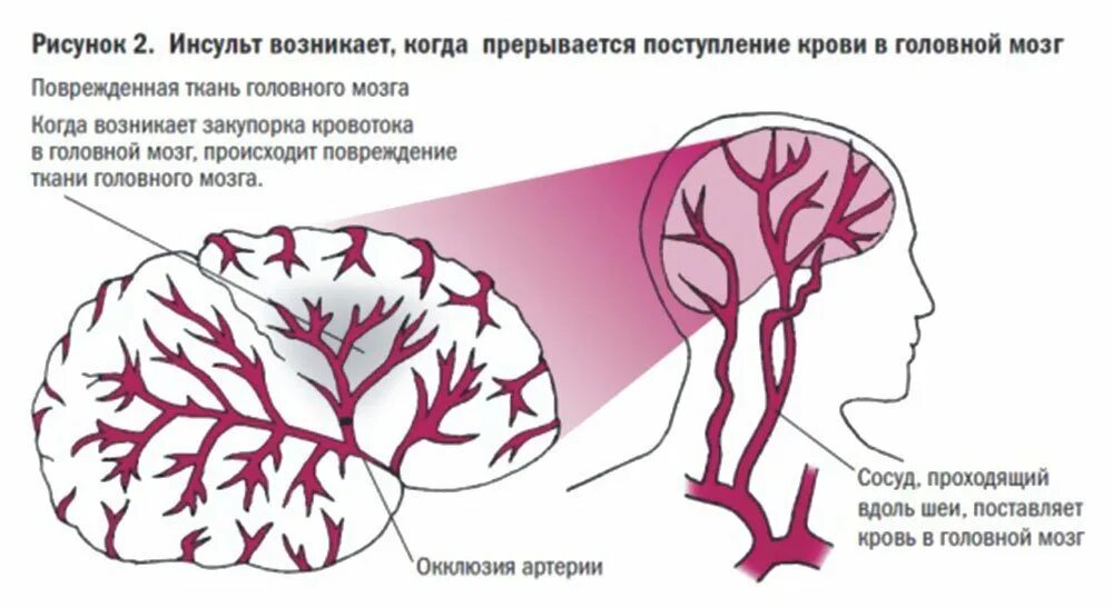 Инсульт левой артерии. Закупорка сосудов головного мозга инсульт. Инсульт рисунок.