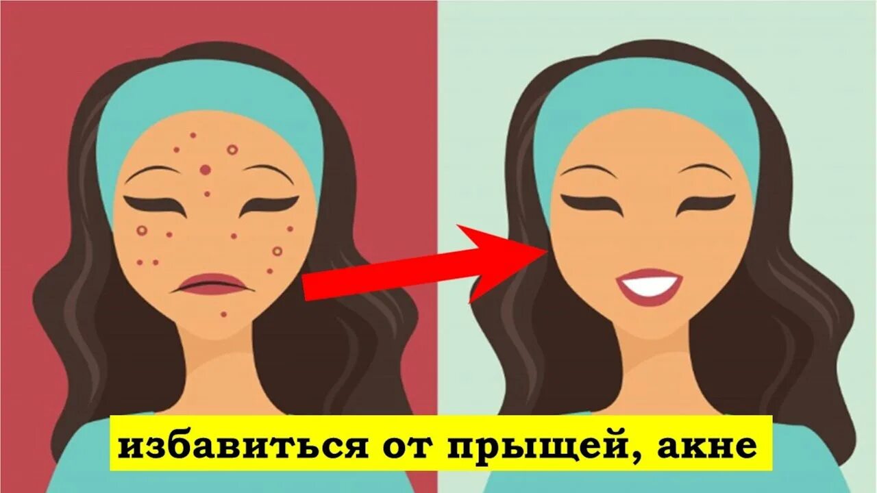 Наклейки чтобы убрать прыщи. Девушка выдавливает акне. Acne program