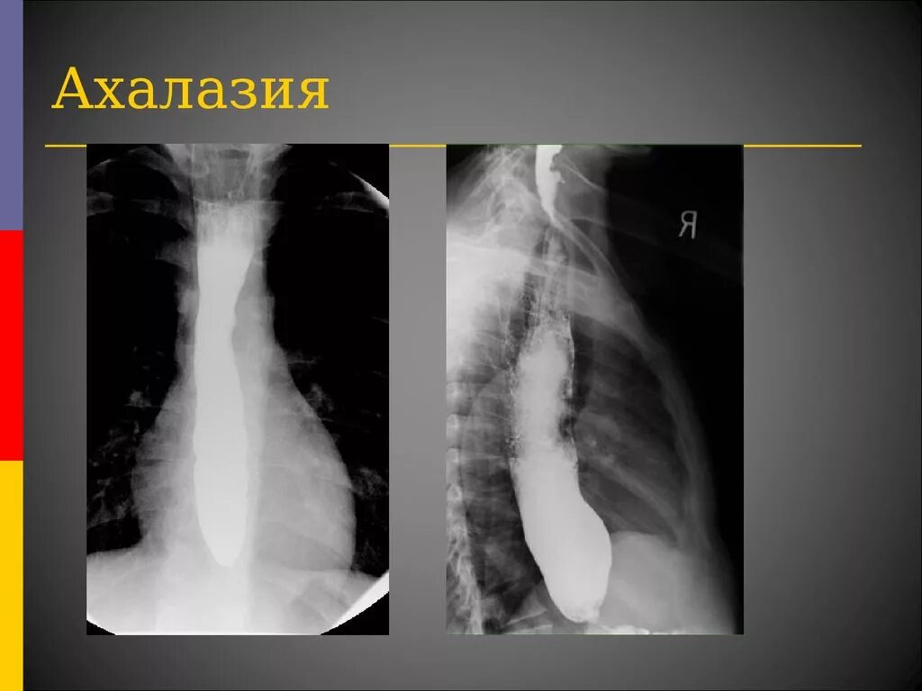 Дилатация пищевода