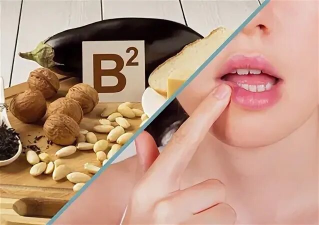 Заеды какие витамины