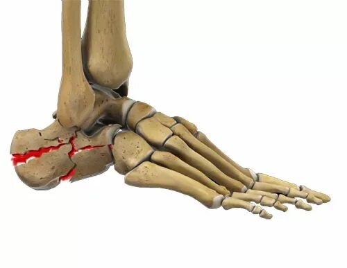 Стопа анатомия кости пяточная кость. Пяточная кость стопы анатомия. Перелом кубовидной кости.