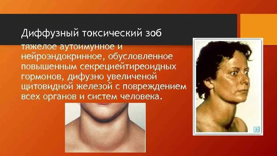 Дифузнотоксический зоб. Диффузный токсичный зоб. Диффузный токсический зоб кожные покровы. Понятие диффузно токсического зоба. Диффузный токсический зоб исследования