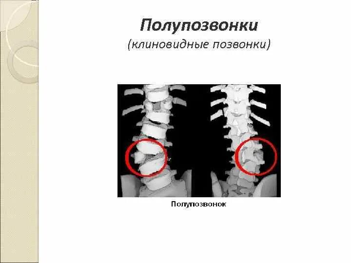 Клиновидный полупозвонок. Клиновидная деформация грудных позвонков. Клиновидная деформация l1 1ст. Полупозвонок грудного отдела позвоночника. Клиновидная деформация th11 позвонка.