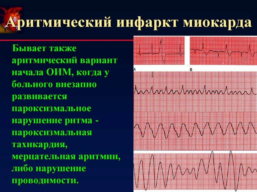 Оим это. Аритмичная форма инфаркта миокарда. При остром инфаркте миокарда Мерцательная аритмия. Инфаркт миокарда Мерцательная аритмия на ЭКГ. Аритмическая форма инфаркта миокарда ЭКГ.