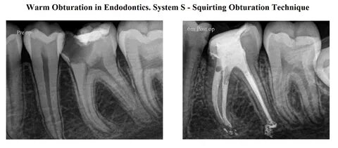 System S - Squirting Obturation Technique in Endodontics News Dentagama.