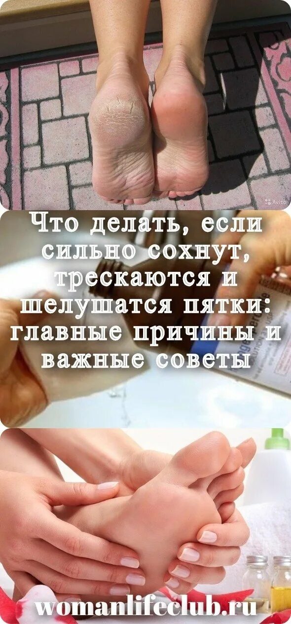 Пятки. Сильно шелушатся пятки. Трескаются пятки что делать.