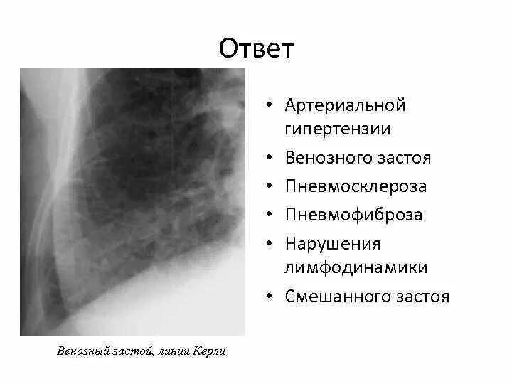 Перегородочные линии Керли. Линии Керли в легких на рентгене. Пневмосклероз рентген описание.