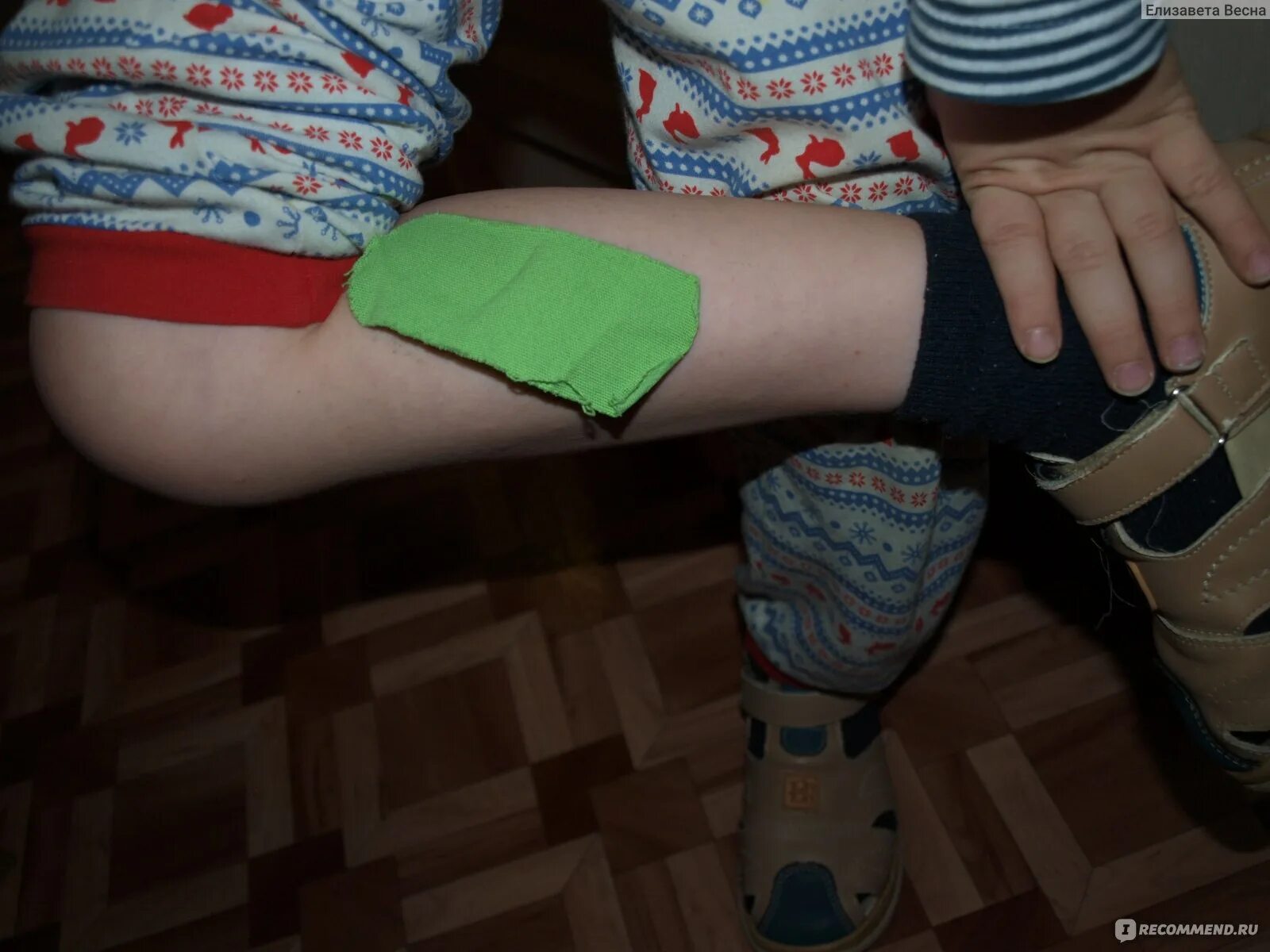 Тейп вальгусных. Тейпирование при вальгусе стоп у детей. тейпы для плоскостопия у детей. тейпирование плоскостопия. тейпирование плосковальгусной стопы.
