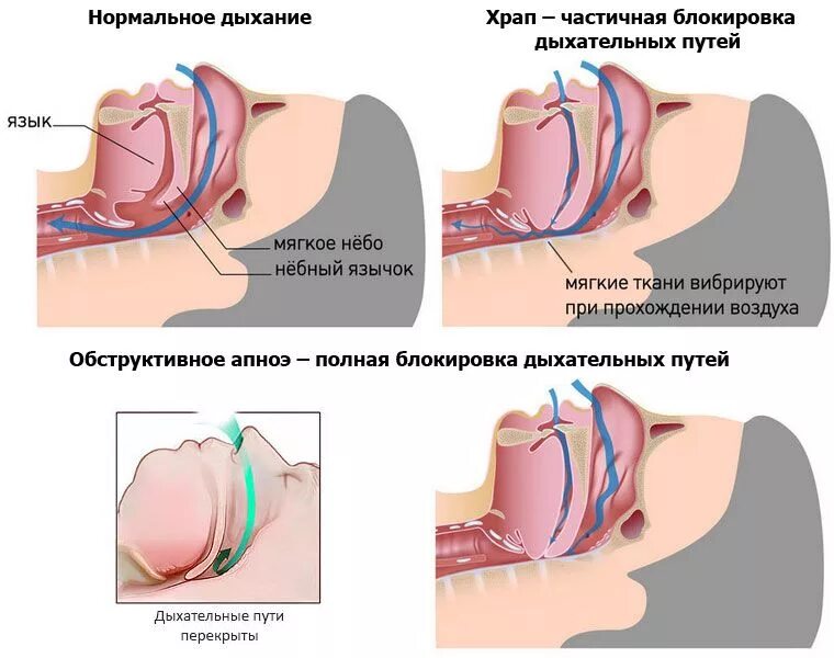 Почему появляется храп. Обструктивное ночное апноэ. Синдром обструктивного апноэ сна. Синдром обструктивного апноэ сна сипап терапия. Аропноэ.