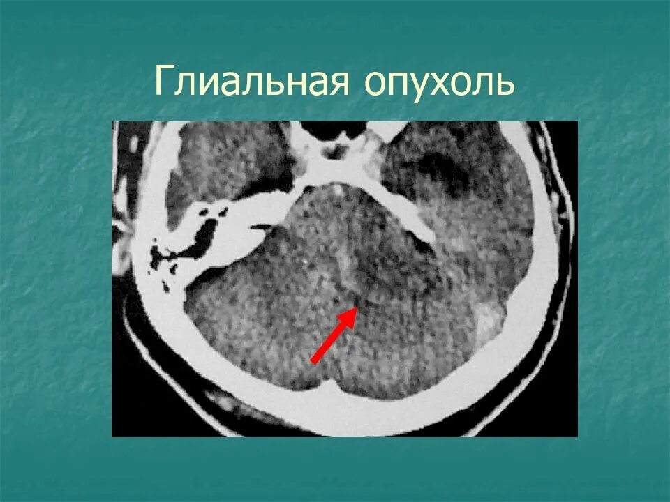 Глиальная опухоль головного мозга кт. Глиальная опухоль височной доли. Глиальная опухоль головного