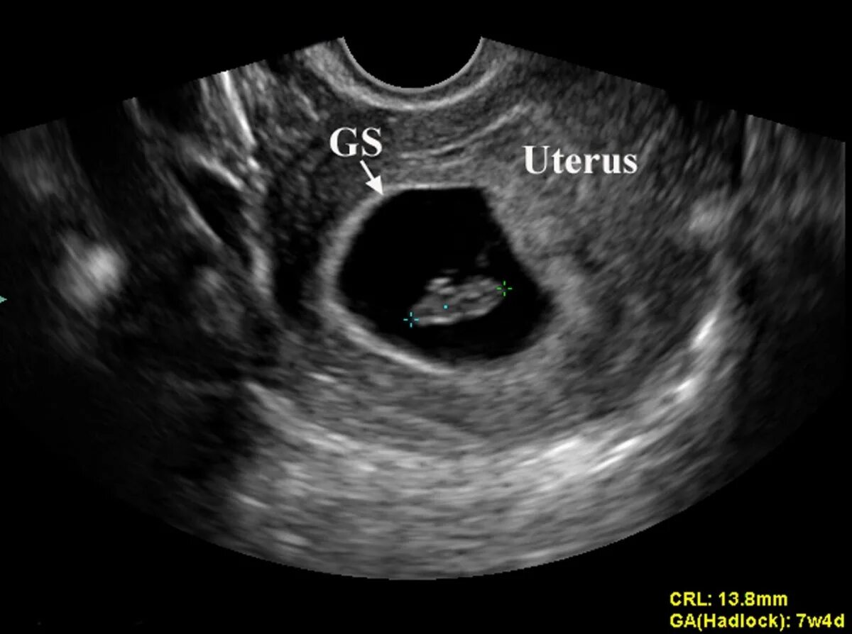 УЗИ беременности на ранних сроках. Снимки УЗИ беременности на ранних. На неделю меньше срока на узи