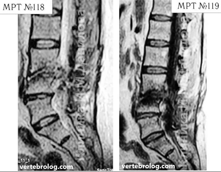 Микродискэктомия грыжи. Грыжа диска после операции. Грыжа диска l5-s1. Грыжа диска после операции. Рецидив грыжи межпозвоночного диска.