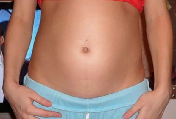 увеличился живот. типы беременных животиков. растет жир на животе у женщин. миома матки растет живот. беременность и жир на животе.