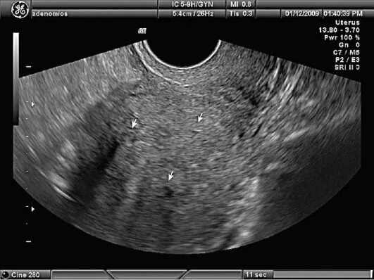 Узи признаки эндометриоза матки. Диффузный эндометриоз матки УЗИ. Внутренний эндометриоз тела матки УЗИ.