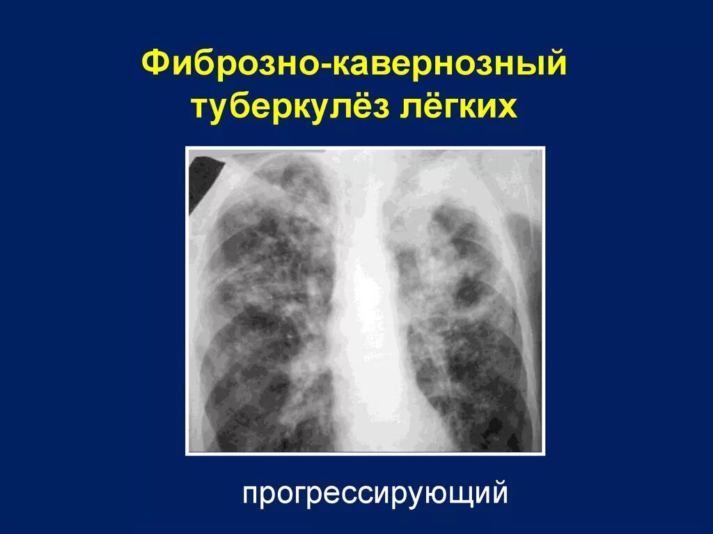 Клинический случай туберкулез. Фибро кавернозный туберкулез рентген. Каверна при туберкулезе на рентгене. Фибринозно кавкрнозный туберкулез рентген. Кавернозный туберкулез патанатомия.
