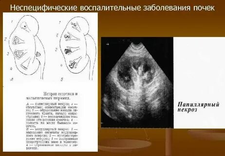 Синдром гиперэхогенных пирамидок