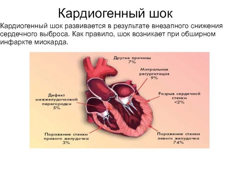 Кардиогенный ШОК. Инфаркт миокарда кардиогенный ШОК. Кардиогенный ШОК при инфаркте миокарда. Причины смерти при кардиогенном шоке. Кардиогенный шок наиболее часто