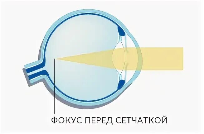 Что фокусирует изображение на сетчатку