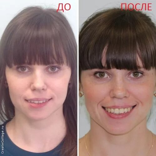 До и После. Когда пластика лица открыла путь к новой жизни / Всё самое лучшее из