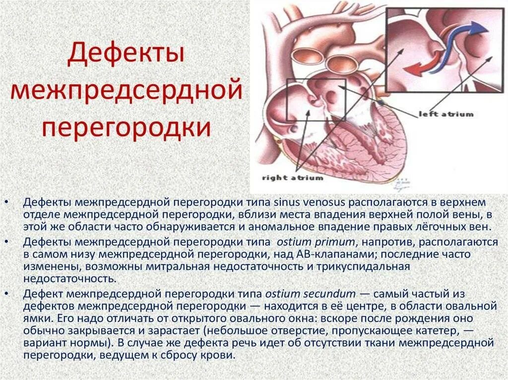 Аневризма перегородки у ребенка. Врожденный порок сердца открытое овальное окно. ВПС открытое овальное окно. Врожденный порок сердца овальное окно. Открытое овальное окно 1,7 мм у ребенка.