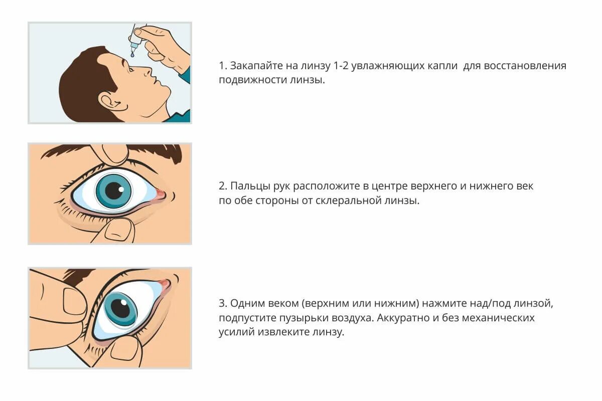 Почему мешает в глазах. Контактная линза потерялась в глазу. Как снять глазные линзы. Лимща потерялась в глазу.