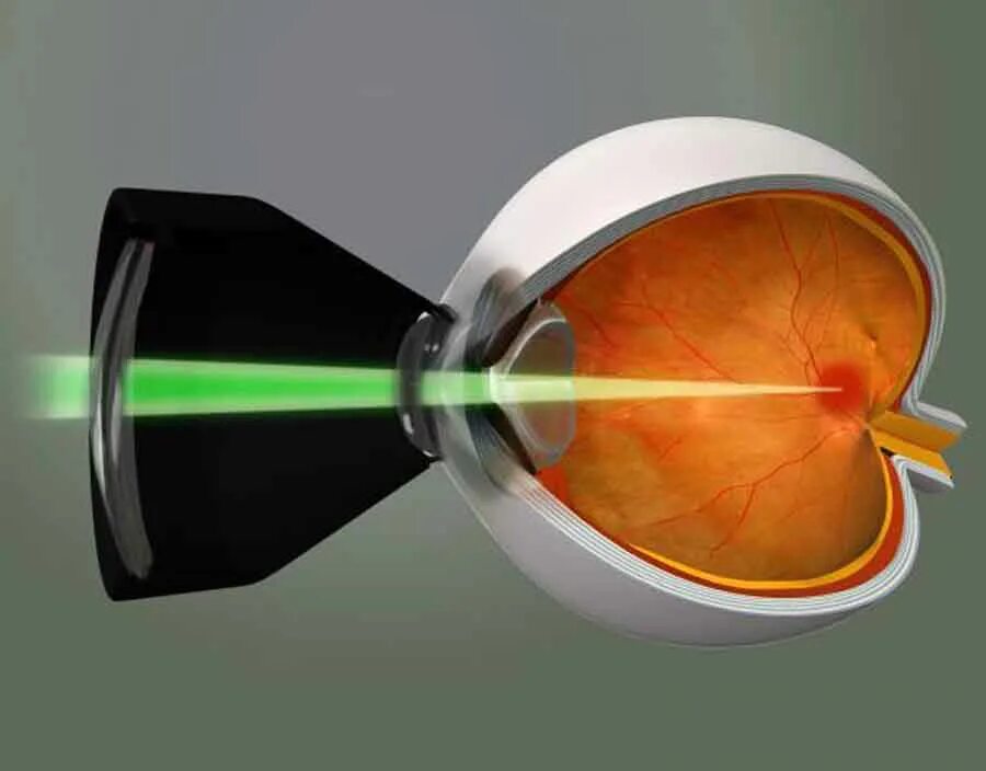 Транспупиллярная лазеркоагуляция. Лазерная коагуляция сетчатки глаза. Офтальма лазерная коагуляция. Транспупиллярная лазеркоагуляция сетчатки.