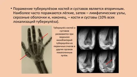 Фазы костно суставного туберкулеза